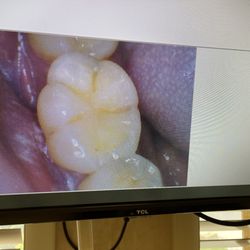 Gallagher & Kuhn Dental Group - Pics of teeth after abrasion has been completed- no filing yet - PLEASE NOTE- NO PAIN