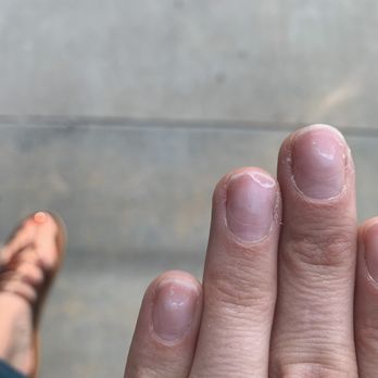Pink & White Nails - Damaged nails post-dip removal - Hair Removal Near Me - Denver, Colorado Pink & White Nails - Damaged nails post-dip removal - Hair Removal Near Me - Denver, Colorado