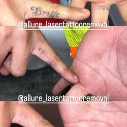 Allure laser Tattoo Removal