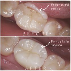 Golden State Dentistry - Restoration by Dr. Tatyana Yashchuk
