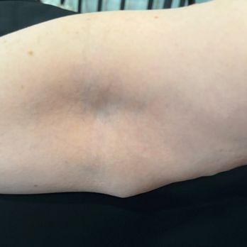 Precision Plastic Surgery - Dog ear on my right elbow - Cosmetic Surgeons Near Me - Rancho Cucamonga, California