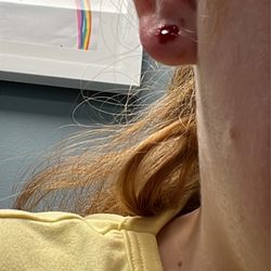 Piercing Pagoda - My ear after I got the earrings removed at the doctors
