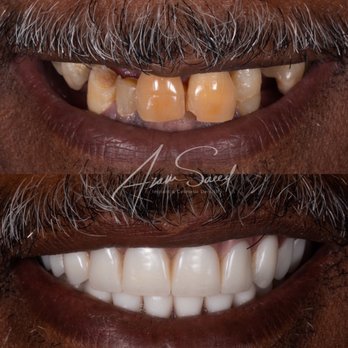 Ace Dental Center - Same day delivery of screwed in teeth that will not fall out, will not come loose, and that you can chew with. - General Dentistry Near Me - Hoffman Estates, Illinois