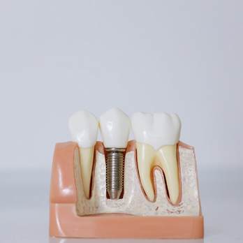 Michael Abelson, DDS MS - Dental Implant Model: Internal View - Periodontists Near Me - Santa Clarita, California Michael Abelson, DDS MS - Dental Implant Model: Internal View - Periodontists Near Me - Santa Clarita, California