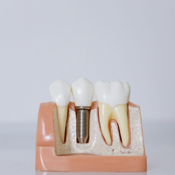 Michael Abelson, DDS MS - Dental Implant Model: Internal View