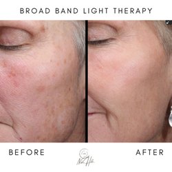 Nob Hill Aesthetics - Broad Band Light Therapy before and after