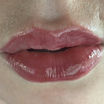 It's a Secret Med Spa - 2 weeks later healed 3 - Medical Spas Near Me - Dallas, Texas