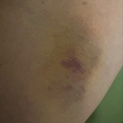Sonora Quest Laboratories - image of my arm on Sat, even after I put heat towel many times, still swollen and getting worst.
