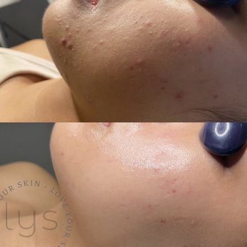 Love Your Skin - Before and after of my skin oh Jasmine's instagram! - Skin Care Near Me - Fremont , California