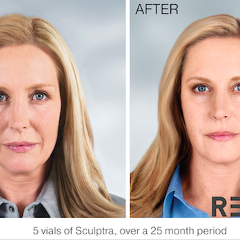 REFINE Medical Spa - 5 vials of Sculptra, over a 25 month period - Medical Spas Near Me - Southlake, Texas REFINE Medical Spa - 5 vials of Sculptra, over a 25 month period - Medical Spas Near Me - Southlake, Texas