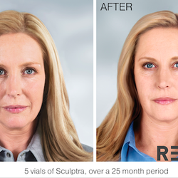 REFINE Medical Spa - 5 vials of Sculptra, over a 25 month period