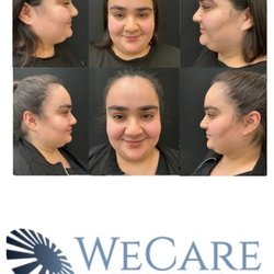 WeCare Eyes and Skin - Did you know that Botox can be used to perform a lip flip. It is injected to subtly enhance the upper lip, for a fuller, more defined look.