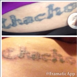Diana D Parnell, MD - After just one treatment of laser tattoo removal! Very good pricing