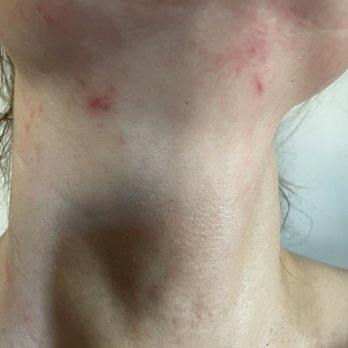 Skinfinity - Cuts made by Karen during dermaplaning. I had to cancel my weekend plans as a result. - Medical Spas Near Me - Dallas, Texas