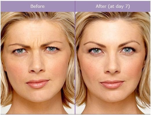 Photo of Hourglass Aesthetics - Lexington, KY, US. Botox before and after