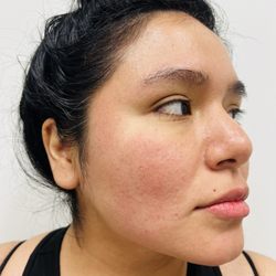Ageless Aesthetics and Wellness - Before treatment