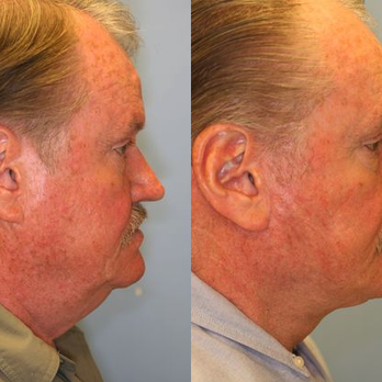 Lee Facial Plastic Surgery - Before and After from Lee Facial Plastic Surgery | Boston, MA - Plastic Surgeons Near Me - Boston, Massachusetts Lee Facial Plastic Surgery - Before and After from Lee Facial Plastic Surgery | Boston, MA - Plastic Surgeons Near Me - Boston, Massachusetts
