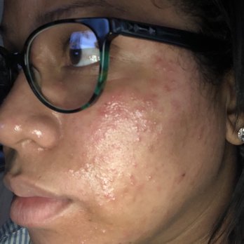 Mindykim Skincare - The very next day before the burning and itching began. - Skin Care Near Me - Miami, Florida Mindykim Skincare - The very next day before the burning and itching began. - Skin Care Near Me - Miami, Florida