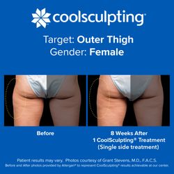 Freeze M.D. CoolSculpting Center - Before and After photos provided by Allergan® to represent results achievable with CoolSculpting.