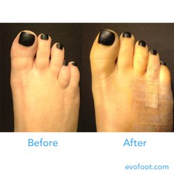 Evo Advanced Foot Surgery - Before and After of our signature aesthetic tow lengthening.