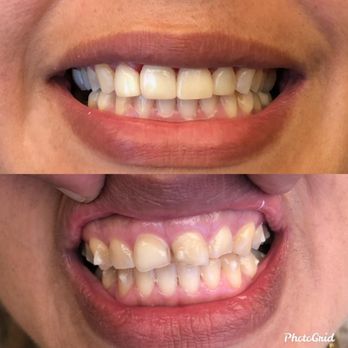 Encinitas Dental Designs - Before and after - General Dentistry Near Me - Encinitas, California