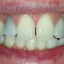 Failing veneers and gapping.