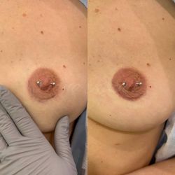 Fancy Shmancy - HEALD results Areola pigmentation correction