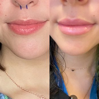 Kendall Breeze Dental Centers - Before and afters of Juvederm lip fillers. - Cosmetic Dentists Near Me - Miami, Florida Kendall Breeze Dental Centers - Before and afters of Juvederm lip fillers. - Cosmetic Dentists Near Me - Miami, Florida