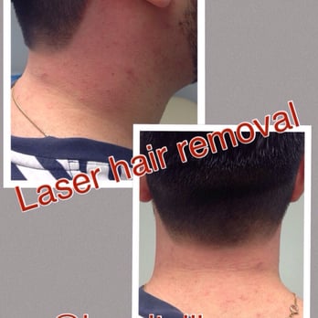 Bare it All Laser - Laser hair removal of hair line - Laser Hair Removal Near Me