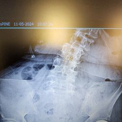 Robert L. Schubert, MD - The fractured spine that Dr. Schubert missed.
