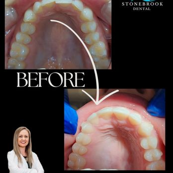 Stonebrook Dental - Before: Misaligned teeth, gaps, or crowding that affect confidence and oral health.
 After: Straight, beautiful teeth that look natural - Cosmetic Dentists Near Me - Frisco, Texas