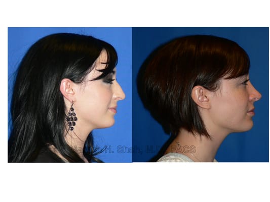 Shah Aesthetic Surgery - Rhinoplasty and Facelift Specialist by null