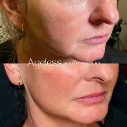 Ageless Medical Spa - Ageless Filler Results