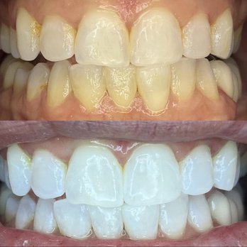 We Whiten - Had no idea how yellow I was - Teeth Whitening Near Me - Las Vegas, Nevada We Whiten - Had no idea how yellow I was - Teeth Whitening Near Me - Las Vegas, Nevada