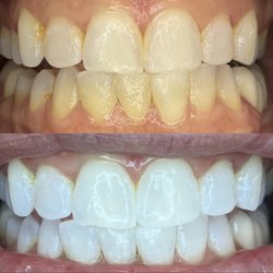We Whiten - Had no idea how yellow I was