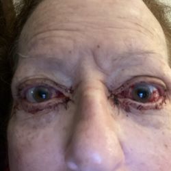 UCLA Stein Eye Institute Cataract & Refractive Surgery - Post surgery and pre surgery