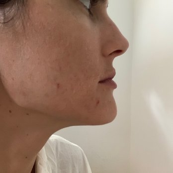 PurefectionLA - Day 7 after first facial! - Estheticians Near Me - Toluca Lake, California