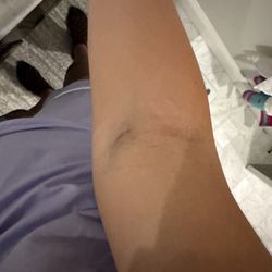 Labcorp - Bruising from blood draw