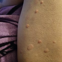 Integrative Family Wellness - More hives, please keep in mind this could have been my throat could have been anaphylaxis and could have killed me. He is dangerous!