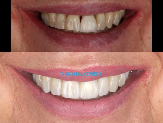 Dental Crowns and Porcelain Veneers - Dental crowns and porcelain veneers are both dental restorative and cosmetic procedures that can help improve the appearance and function of teeth. However, they serve different purposes and have distinct characteristics:

    Dental Crowns (also known as dental caps):
        Purpose: Dental crowns are used to restore and protect a damaged or weakened tooth. They are often recommended for teeth with extensive decay, cracks, fractures, or after root canal treatment. Crowns can also be used to improve the appearance of misshapen or discolored teeth.
        Material: Crowns can be made from various materials, including metal, porcelain-fused-to-metal (PFM), all-ceramic, and zirconia. The choice of material depends on factors like durability, aesthetics, and the location of the tooth in the mouth.

    Porcelain Veneers:
        Purpose: Porcelain veneers are primarily used for cosmetic purposes to enhance the appearance of teeth. They are often recommended for teeth that have aesthetic issues, such as staining, discoloration, minor chips, gaps, or slight misalignment. Veneers can create a more uniform and attractive smile.
        Material: Veneers are typically made from thin shells of porcelain, which closely mimic the appearance of natural teeth. They are designed to be translucent and provide a natural-looking result.
        Procedure: The process of getting porcelain veneers involves minimal tooth preparation, where a small amount of enamel is removed from the front surface of the teeth to make room for the veneers. An impression or scan is then taken, and the veneers are custom-made to bond to the prepared teeth. Once fabricated, the veneers are permanently bonded to the teeth, improving their appearance.

In summary, dental crowns are primarily used for restoring and protecting damaged or weakened teeth, while porcelain veneers are mainly used for cosmetic purposes to enhance the appearance of healthy teeth. Both procedures can improve the overall aesthetics of your smile, but the choice between them depends on your specific dental needs and goals. 

Call or Schedule a Consultation Online to discuss the most suitable option for your situation.