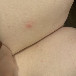 Skanstulls Hostel - My legs after being bitten by bedbugs at this hostel (min ben bett av väggloss på hostel)