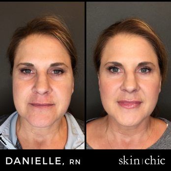 Skin Chic - Southgate Mall - Total facial rejuvenation: Voluma in cheeks, Juvederm in lips, and Botox to soften lines. - Makeup Artists Near Me - Missoula, Montana