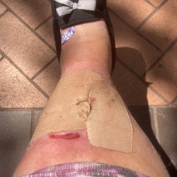 Signature Urgent Care - My wound on my leg I wanted them to look at.
