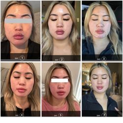 The Facebar Aesthetic Medicine - Vi peel purify and precision plus process