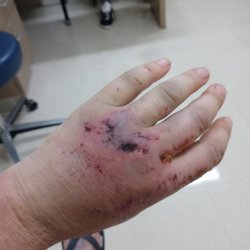 UMass Memorial - One of the many injuries that went un cared for in ER ... not to mention they removed my neck brace without even a quick physical check