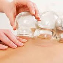 Orange County Acupuncture and Herbs - Cupping is great for relieving muscle tightness, improving circulation and facilitating elimination of toxins and stagnant blood.