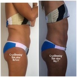 Flow Cryotherapy - CryoSlimming- Female before and after