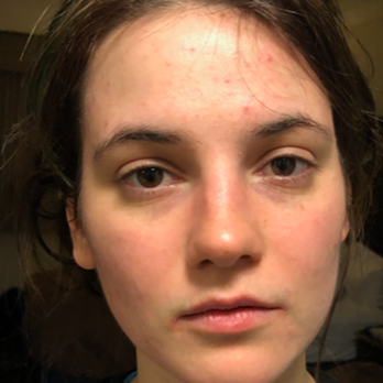 Recover From Mold - #2 Right after my treatment I felt the tension leave my face, saw, and felt immediately different. - Osteopathic Physicians Near Me - Pittsburgh, Pennsylvania Recover From Mold - #2 Right after my treatment I felt the tension leave my face, saw, and felt immediately different. - Osteopathic Physicians Near Me - Pittsburgh, Pennsylvania