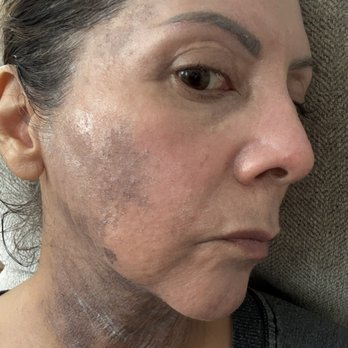 Medspa Deluxe LA - The process. New skin coming in. One week after my procedure. - Skin Care Near Me - Rancho Cucamonga, California