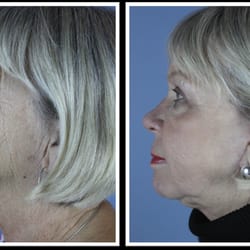 Vargas Face and Skin Center - Procedure: Deep Laser Resurfacing

Actual patient of Dr. Hannah Vargas